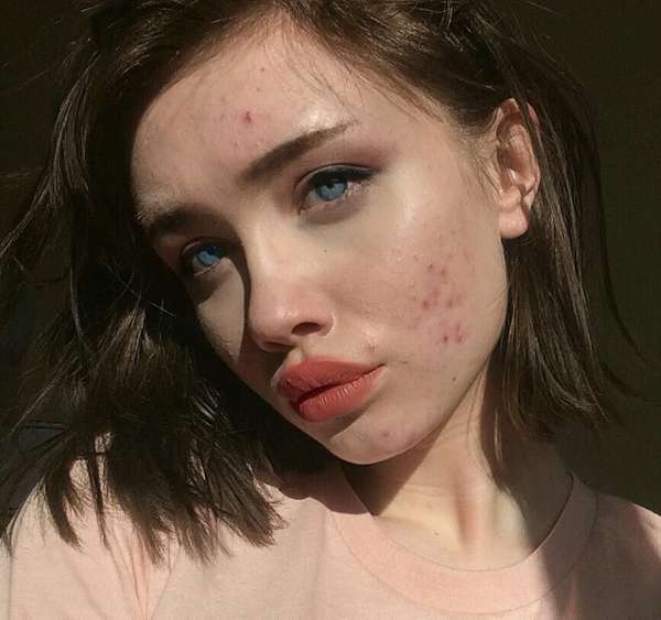 Vì sao cứ tới hè là các nốt mụn lại thi nhau mọc lên?