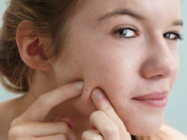 cách phòng tránh sẹo rỗ hiệu quả