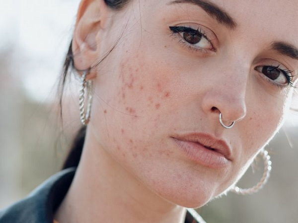 Phân Biệt Các Loại Mụn Và Cách Điều Trị Phù Hợp