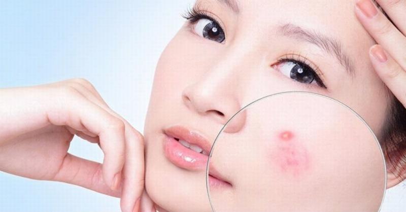 mụn- nổi ám ảnh