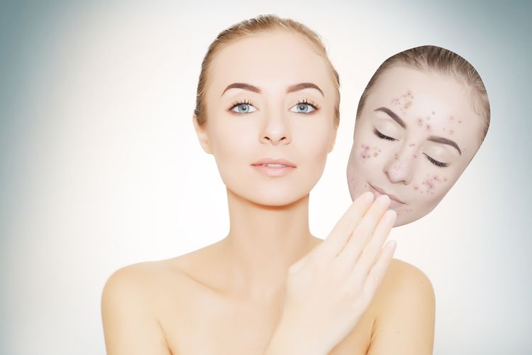  Thâm mụn hoặc là sẹo thâm trên da là hậu quả của việc chăm sóc mụn sai cách