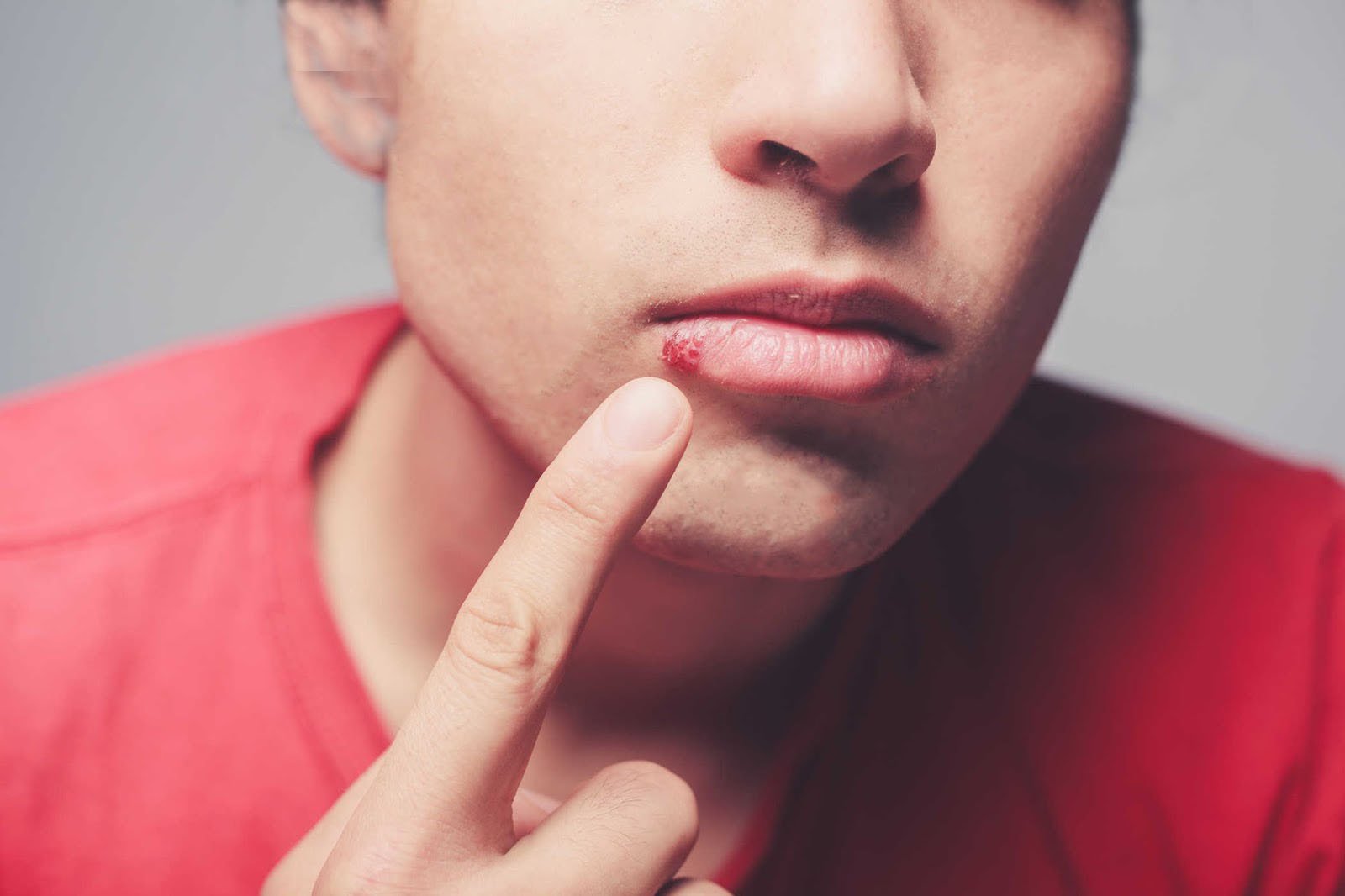 Trời Này Rất Dễ Bị Chốc Mép Nhưng Mấy Ai Biết Cách Xử Lý Bệnh Hiệu Quả