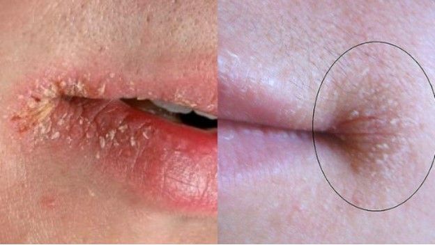 Trời Này Rất Dễ Bị Chốc Mép Nhưng Mấy Ai Biết Cách Xử Lý Bệnh Hiệu Quả