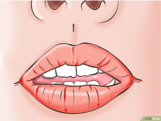 Trời Này Rất Dễ Bị Chốc Mép Nhưng Mấy Ai Biết Cách Xử Lý Bệnh Hiệu Quả