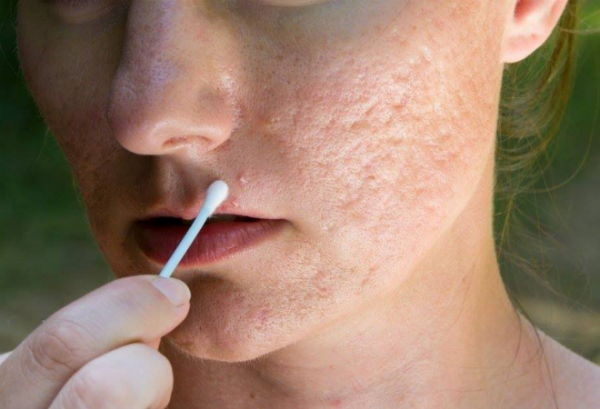 Hướng Dẫn Phương Pháp Lăn Kim Điều Trị Phù Hợp Các Loại Sẹo Rỗ