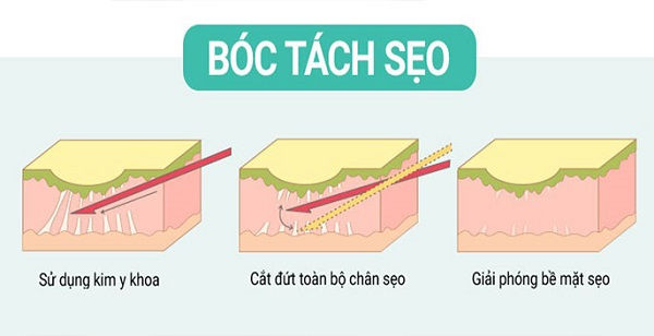 Tìm Hiểu Về Phương Pháp Bóc Tách Đáy Sẹo Điều Trị Sẹo Rỗ