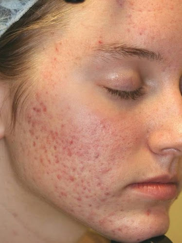 Tìm Hiểu Về Phương Pháp Bóc Tách Đáy Sẹo Điều Trị Sẹo Rỗ