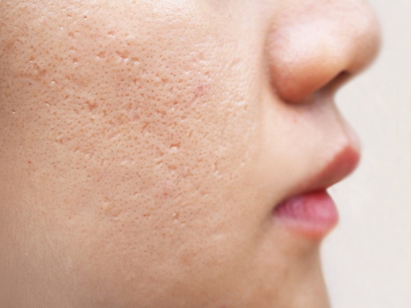 Tìm Hiểu Về Phương Pháp Bóc Tách Đáy Sẹo Điều Trị Sẹo Rỗ