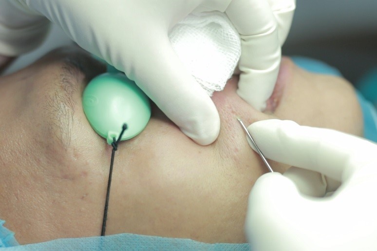 Tìm Hiểu Về Phương Pháp Bóc Tách Đáy Sẹo Điều Trị Sẹo Rỗ