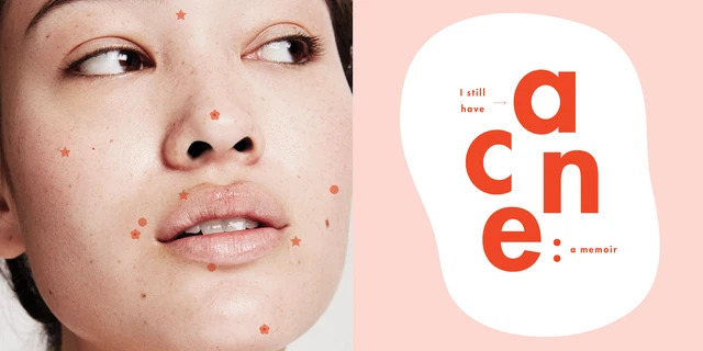 Những Điều Lầm Tưởng Về Mụn Có Thể Bạn Chưa Biết