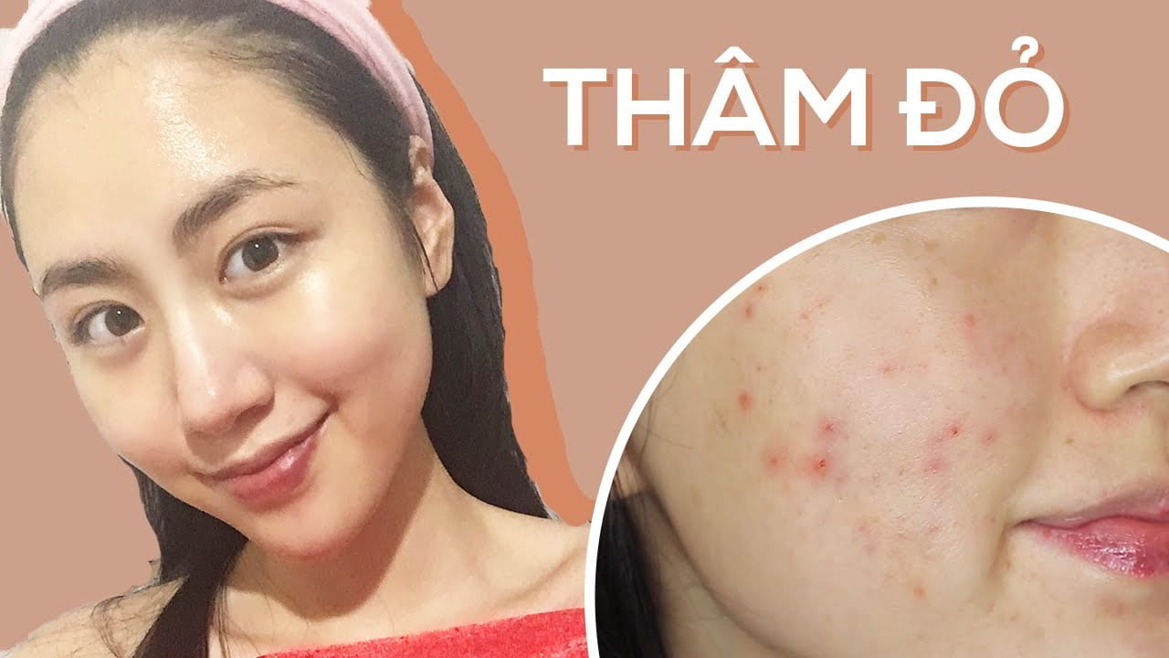 Thâm Đỏ Sau Mụn: Nguyên Nhân Và Sản Phẩm Điều Trị Thâm Hiệu Quả