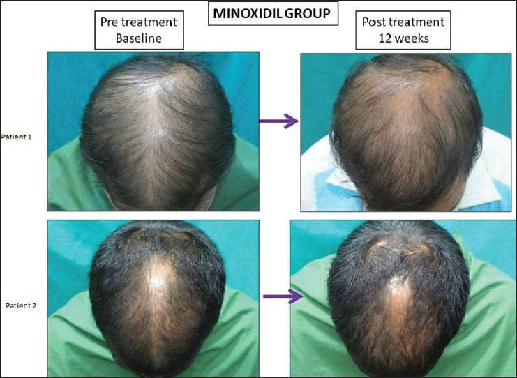 Hình ảnh trước và sau sử dụng kim lăn trị hói đầu