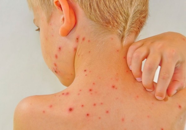 Bệnh sẹo thâm để lại những vết sẹo xấu xí trên da