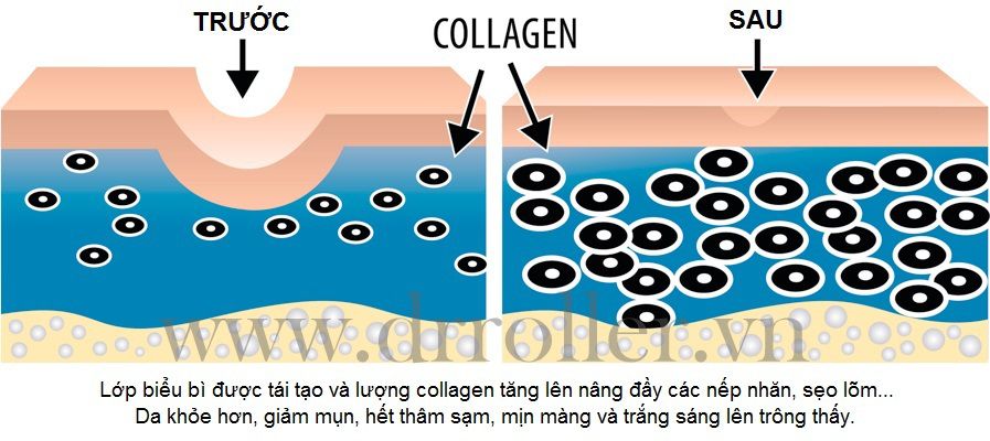 Lăn kim trị sẹo rỗ tại nhà hiệu quả nhất