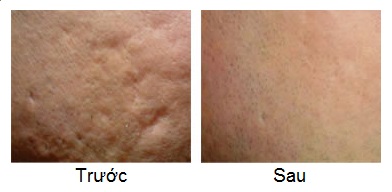Kết quả lăn kim trị sẹo lõm 