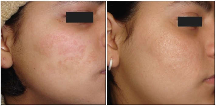 Trị sẹo lõm bằng lăn kim