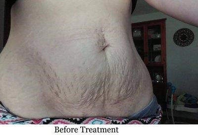 Hình ảnh trước lăn kim trị rạn da