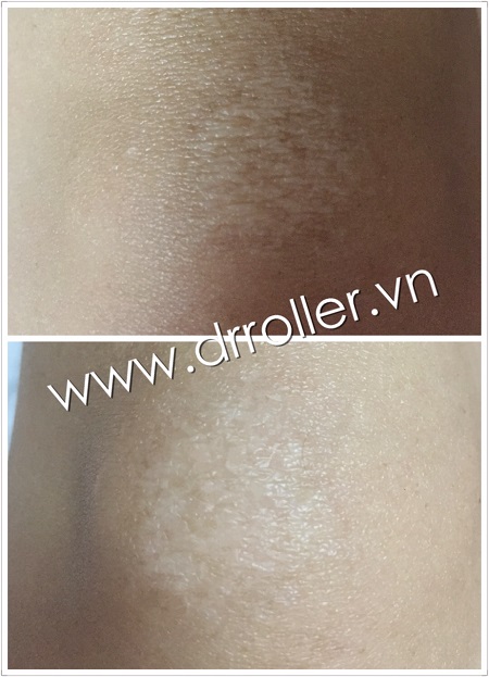 Trị sẹo với kim lăn Dr. Roller