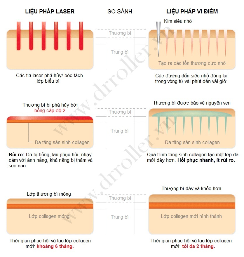 So sánh phương pháp lăn kim với các phương pháp laser