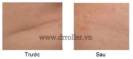 Hiệu quả trị sẹo lõm với Dr. Roller