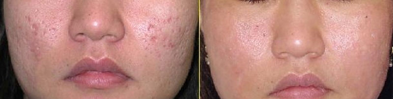Kết quả lăn kim trị sẹo lõm 