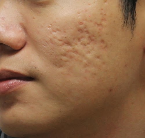 “Bỏ túi” 3 công thức trị sẹo lõm bằng nghệ tươi