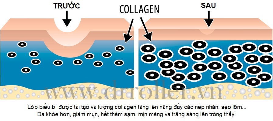 Lăn kim trị sẹo lõm (sẹo rỗ) có thật sự hiệu quả không?